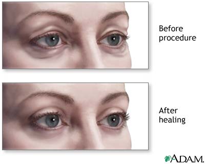 Blefaroplastia 4