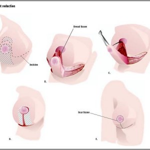 mastopexia con prótesis