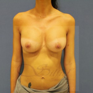 aumento mamario transmuscular