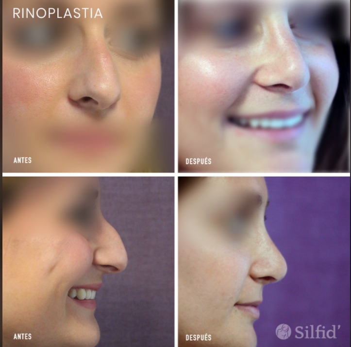 Rinoplastia ultrasónica Alicante