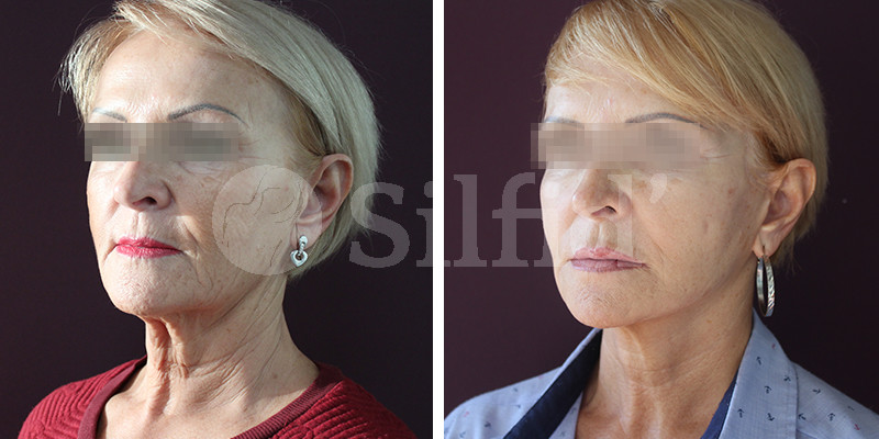 Lifting Facial  Clínicas Estética Santander y Valladolid