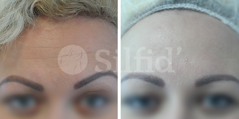 botox_alicante_01