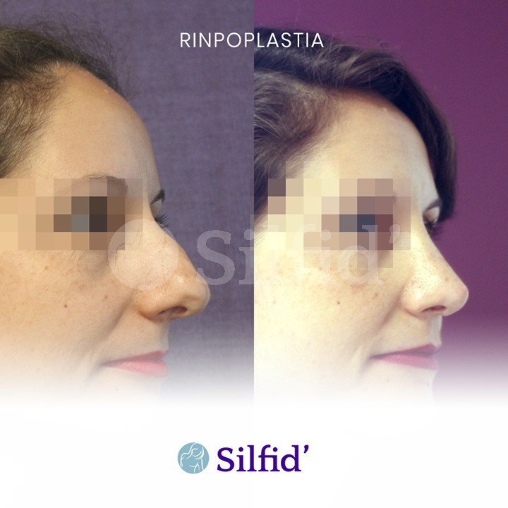 rinoplastia funcional en Alicante