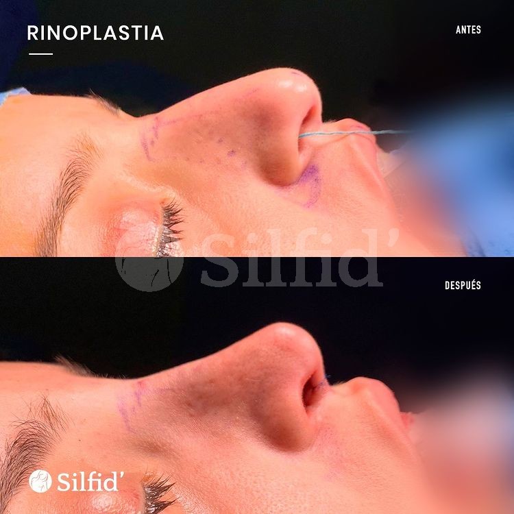 rinoplastia funcional en Alicante