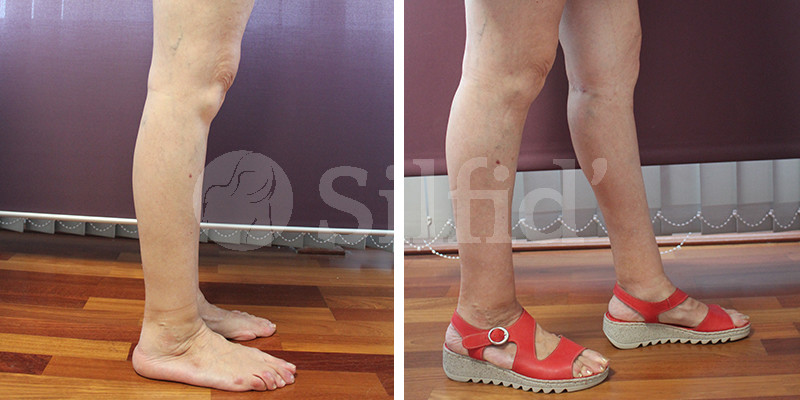 Aumento de gemelos en alicante