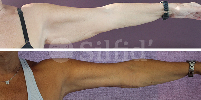 Lifting de brazos en Alicante