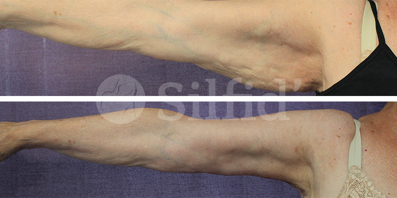 Lifting de brazos en Alicante