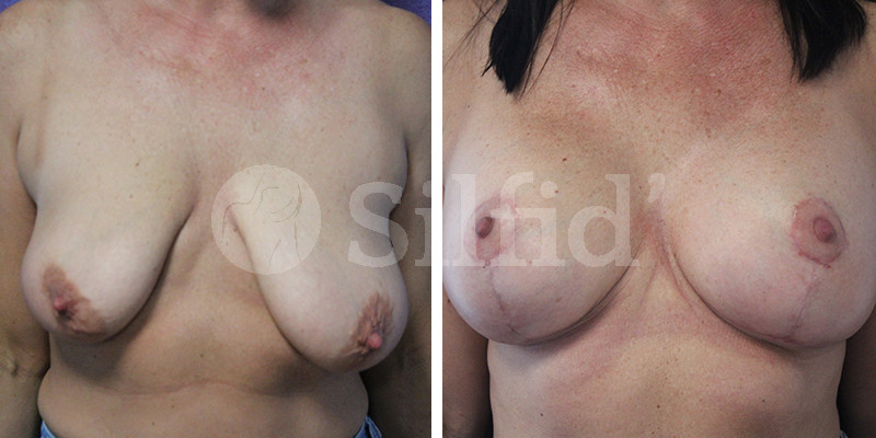 Elevación de pecho en Alicante