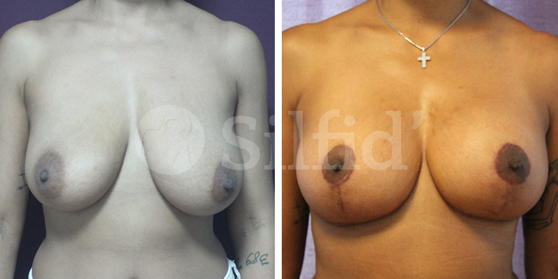 Elevación de pecho en Alicante