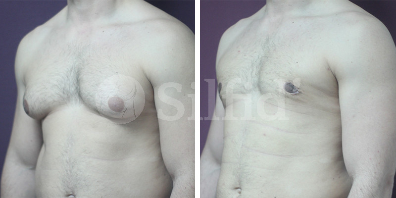 ginecomastia_alicante_01