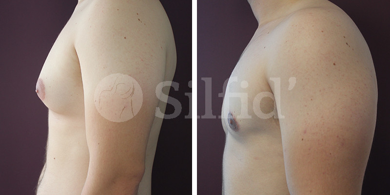 ginecomastia_alicante_03