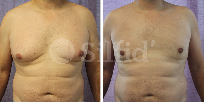 ginecomastia_alicante_04